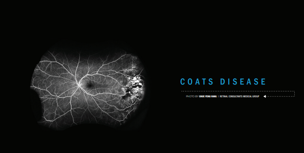 Coats Disease