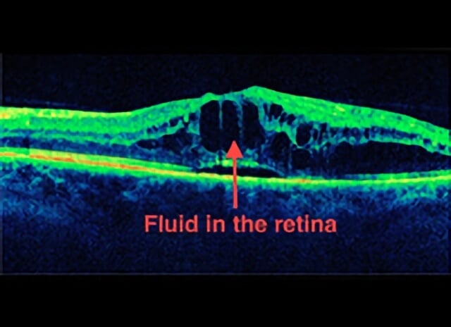 Central Vein Occlusion 02