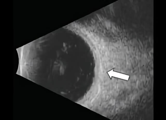Choroidal Nevus 03