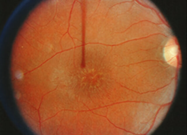 Congenital x-linked retinoschisis 1
