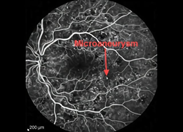 Diabetic Macular Edema 03