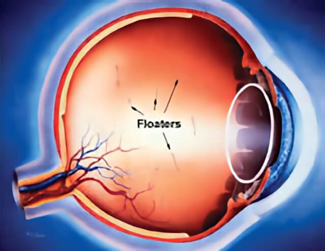 Flashers Floaters 01