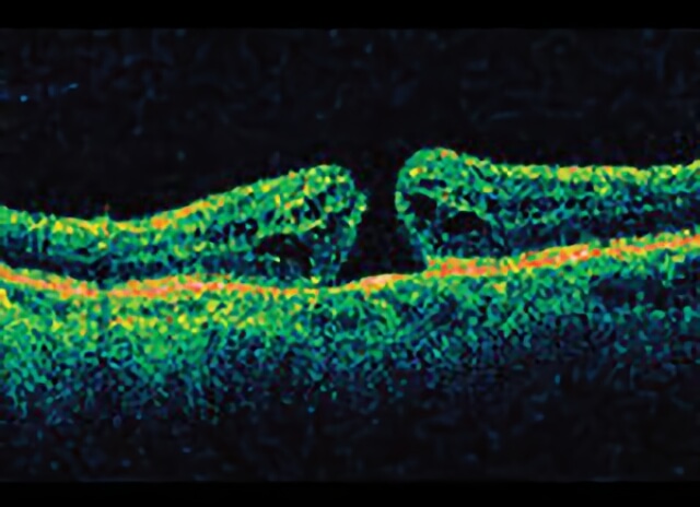 Macular Hole 02
