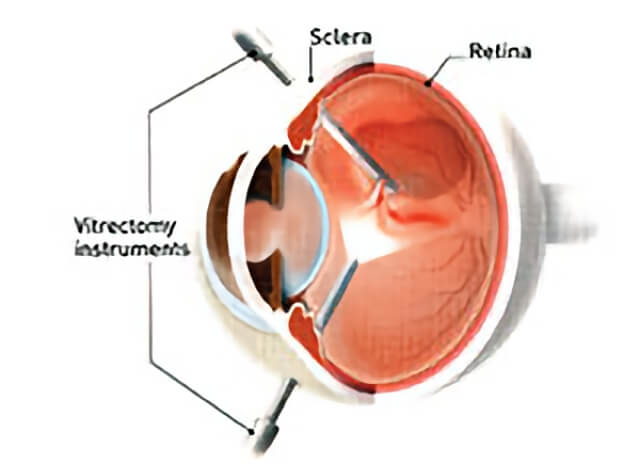 Macular Hole 03