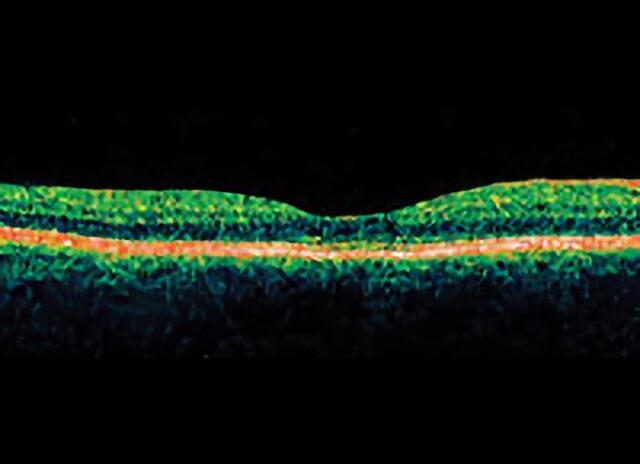 Macular Hole 04