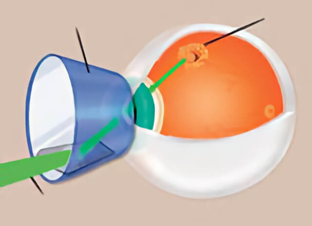 Retinal Tear 02