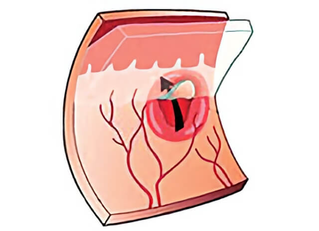 Retinal Tear 01