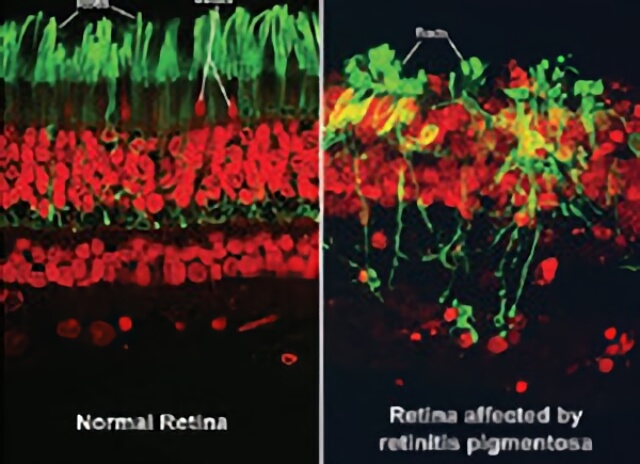 Retinitis Pigmentoda 05