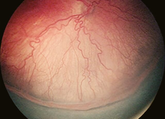Retinopathy of Prematurity 1