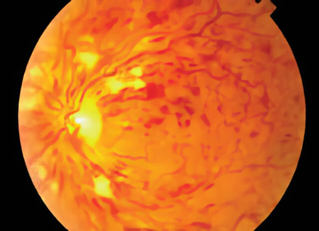 Vein Occlusion 01