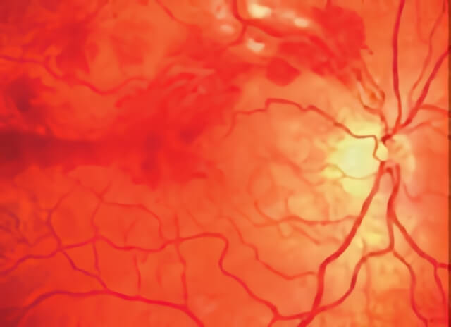 Vein Occlusion 05