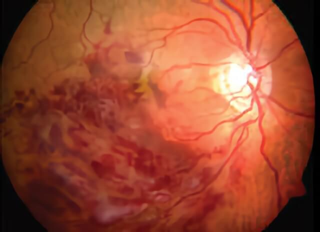 Vein Occlusion 04