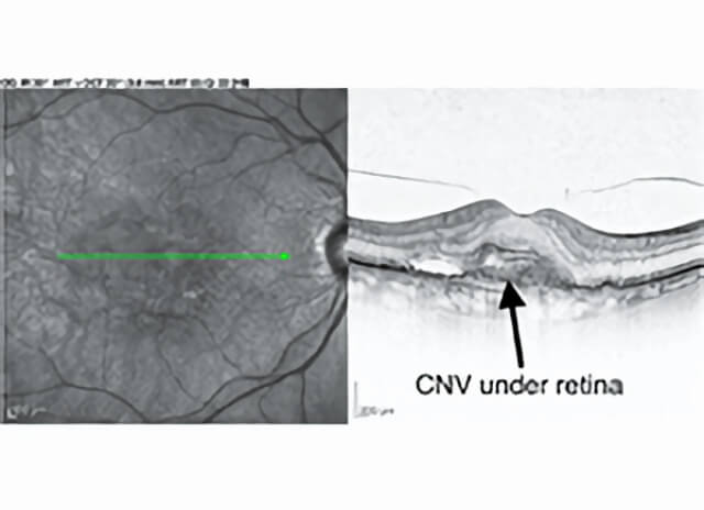 Retina Specialist - Why should I see one? - SK Retina