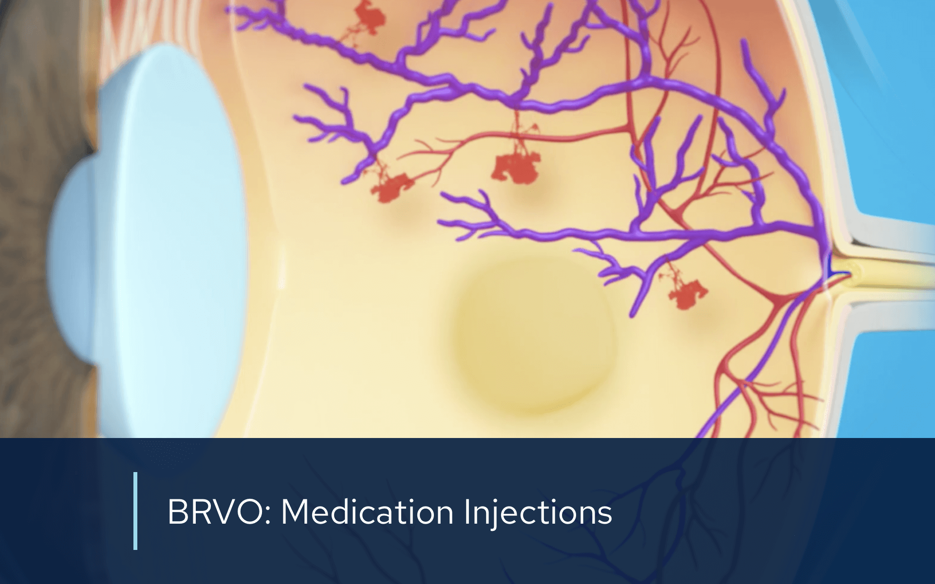 Video retina brvo medication injections