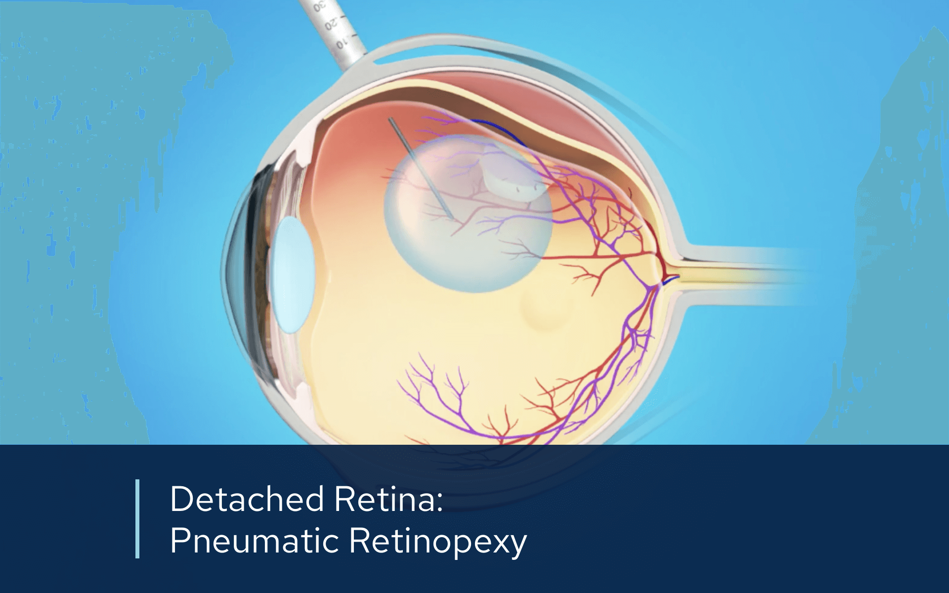 Video detached pneumatic retinopexy