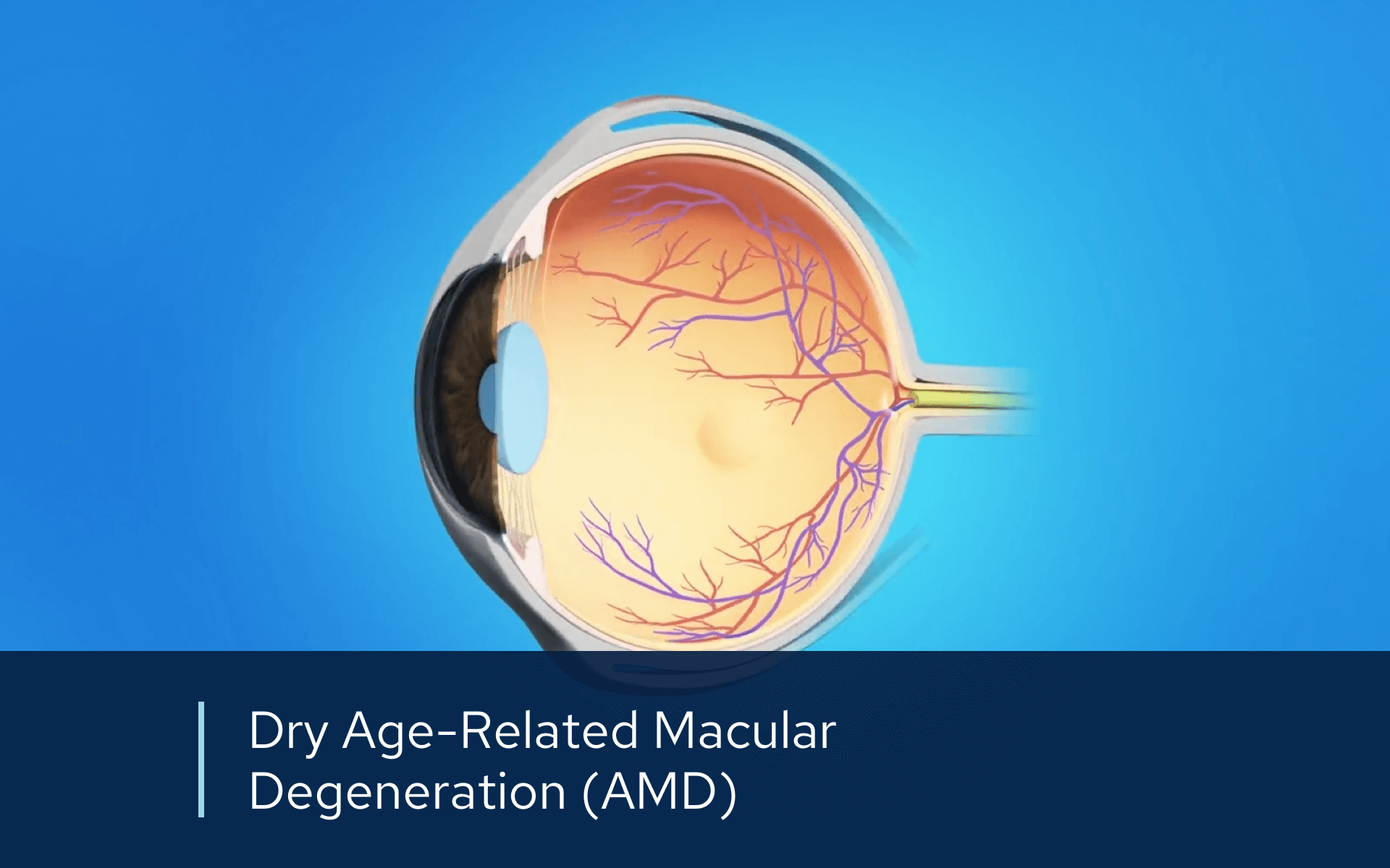 Video retina dry amd