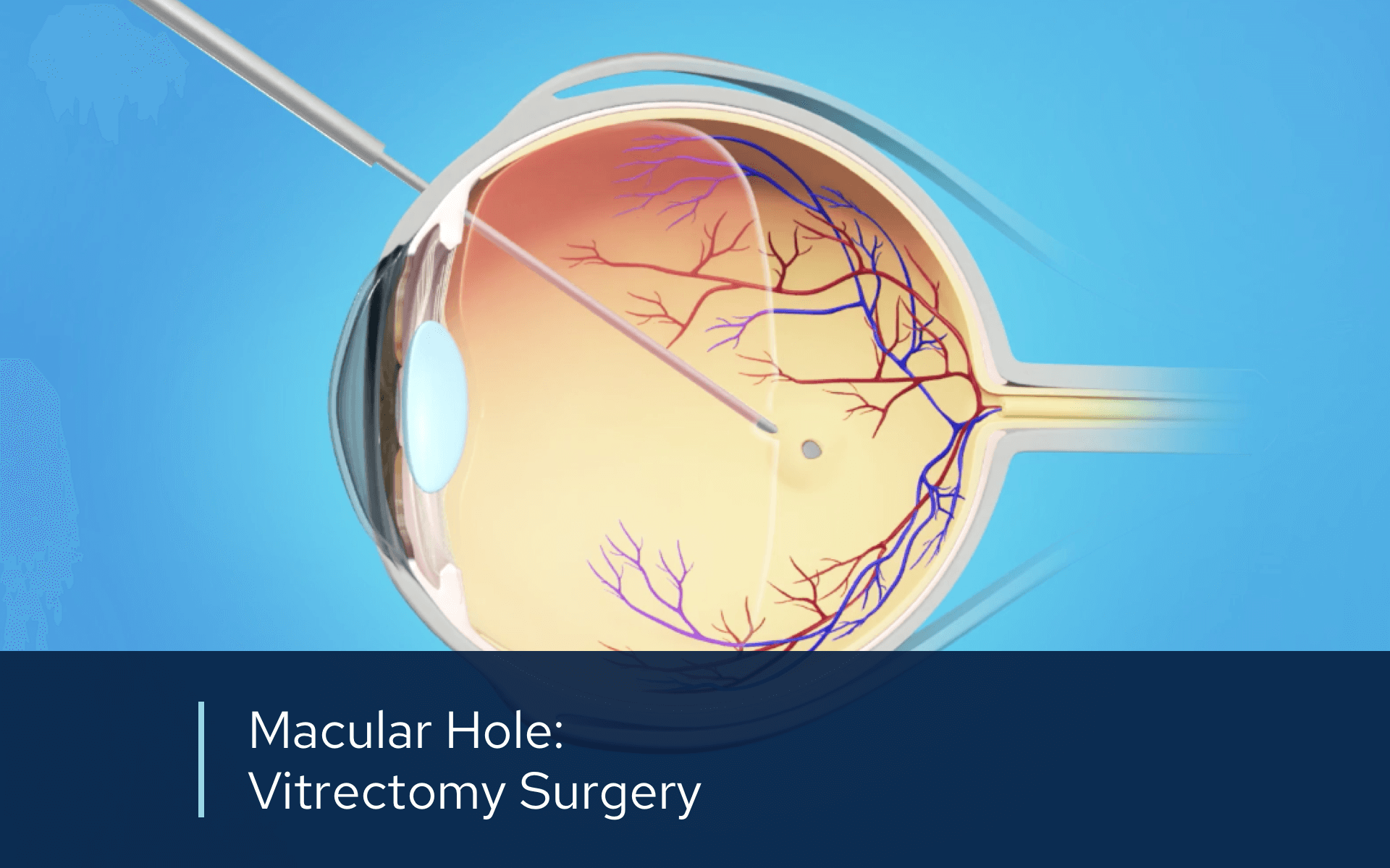 Vitrectomy Surgery Retinal Consultants Medical Group vitrectomy-surgery-retinal-consultants-medical-group